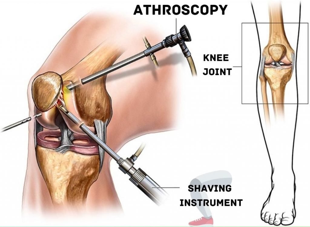 Knee arthroscopy