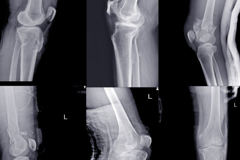 knee fracture x-ray image shows cracks swellings